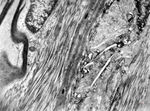M,3y. | globoid leukodystrophy of Krabbe - n.suralis M,3y. | globoid leukodystrophy of Krabbe - n.suralis
